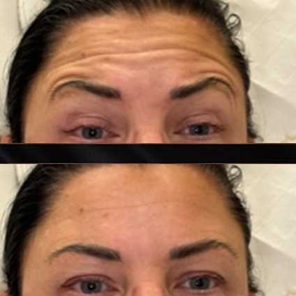 Anti Wrinkle Injections