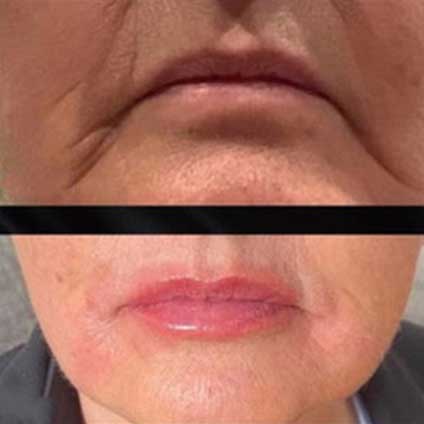 Derma Filler